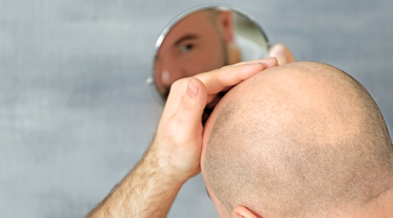 Is everyone suitable for hair transplantation – patient eligibility check at MedHair Clinic in Istanbul, Turkey