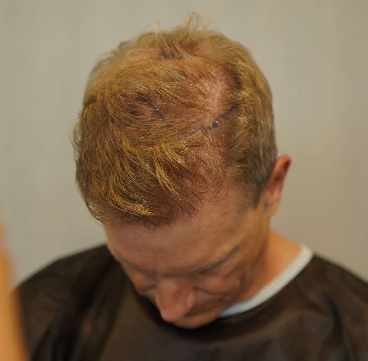 Haartransplantation Tonsur vorher nachher mit 3200 Grafts