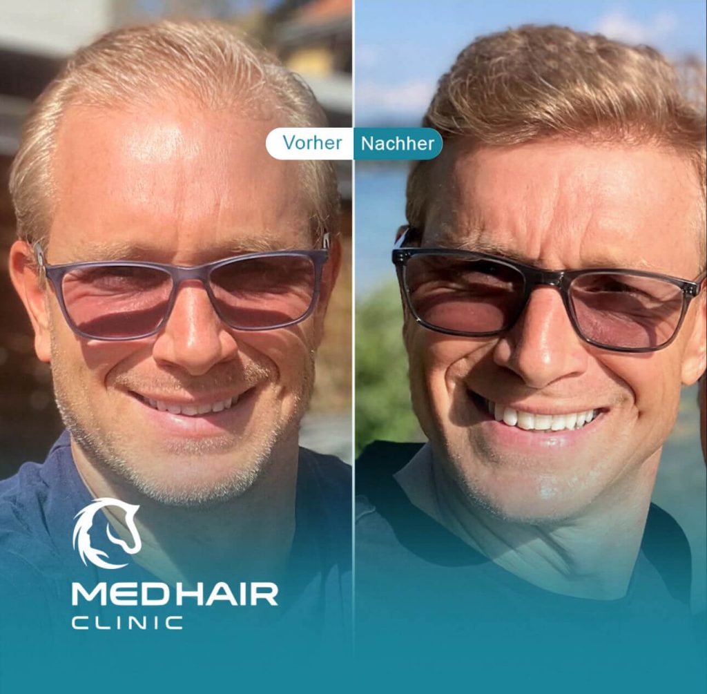 Haartransplantation vorher nachher Patientenbewertung
