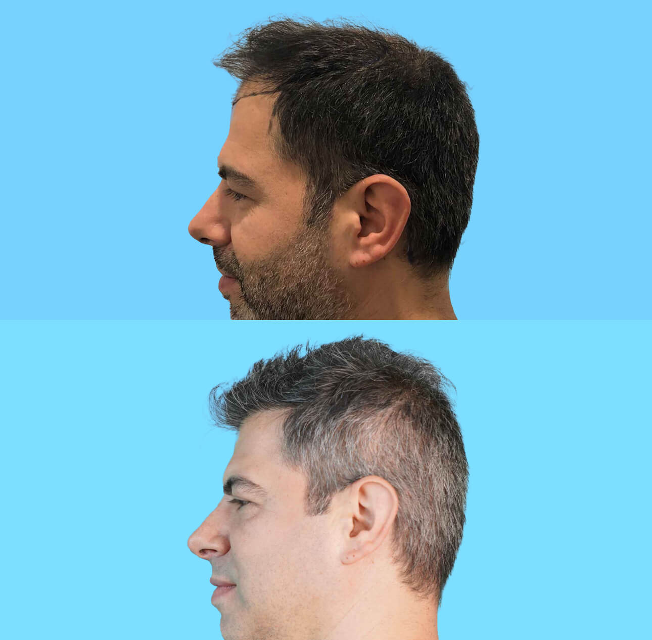 Seitlicher Vorher Nachher Vergleich Haartransplantation 3400 Grafts