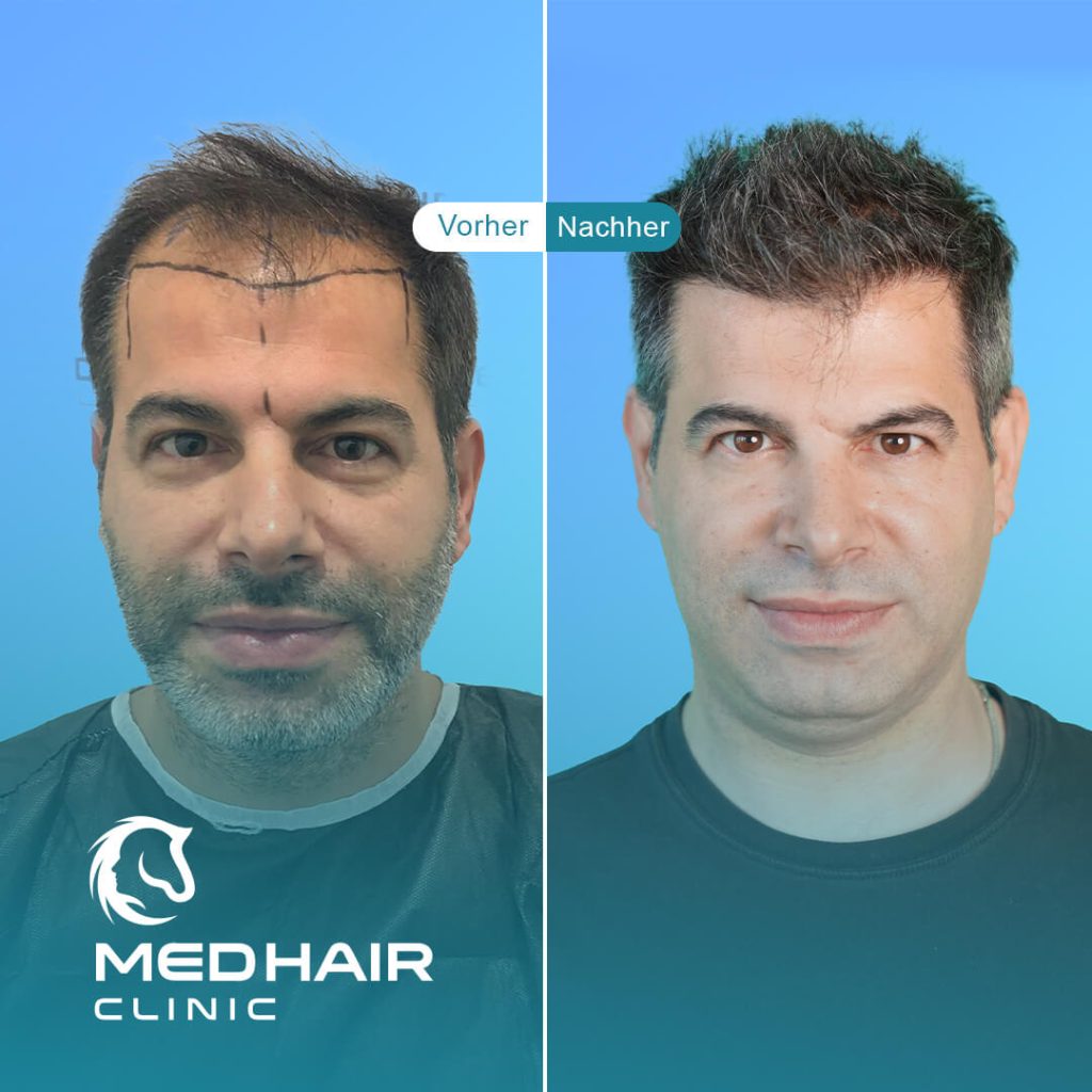 Peter nach Haartransplantation mit 3400 Grafts