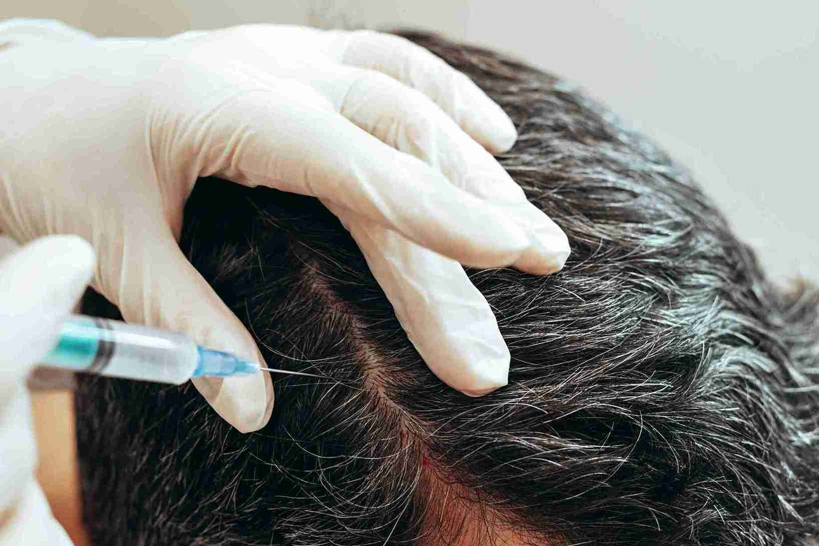 A gloved medical professional parts a person’s hair and injects a syringe into the scalp, performing mesotherapy for hair growth and scalp health.