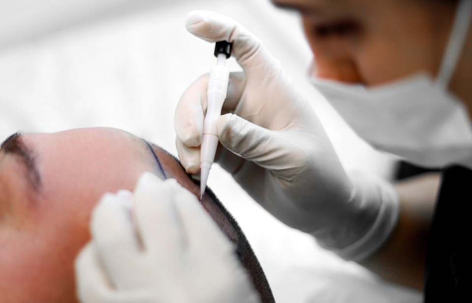 Mann bekommt eine Haartransplantation mit der Saphir Methode.