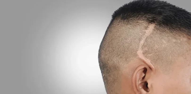 Cicatrici Trapianto Di Capelli