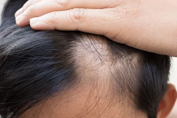 Cosa Dovrei Fare Per Prevenire La Caduta Dei Capelli?