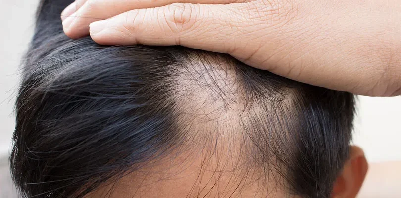 Cosa Dovrei Fare Per Prevenire La Caduta Dei Capelli