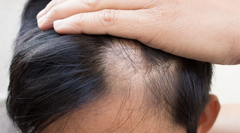 Cosa Dovrei Fare Per Prevenire La Caduta Dei Capelli