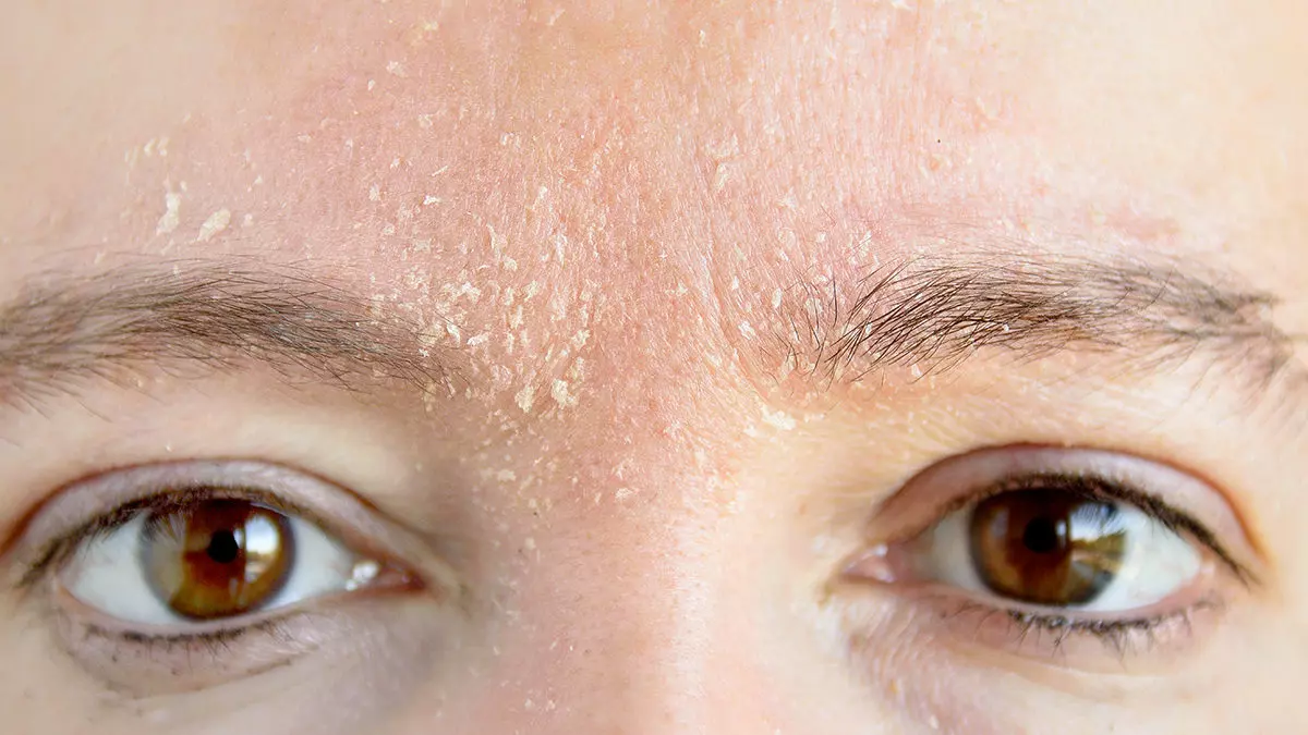 Kaş Dökülmesi Neden Olur​?