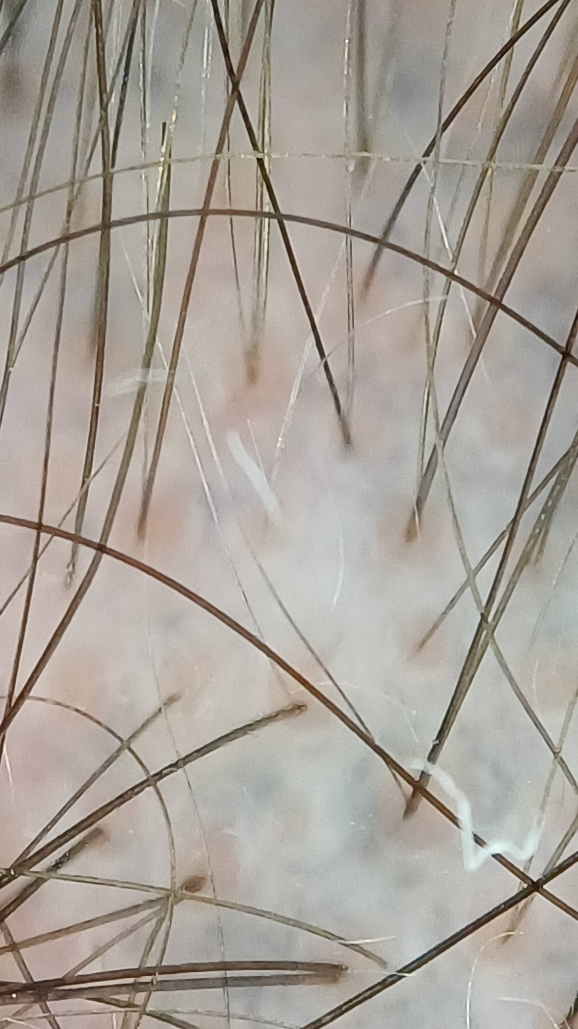 Haaranalyse zur Bestimmung der Grafts und Bewertung von Haardichte und Haarqualität