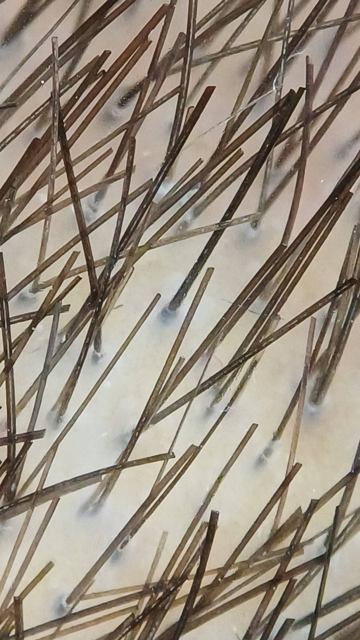 Haaranalyse zur Identifikation starker und gesunder Grafts für eine erfolgreiche Haartransplantation