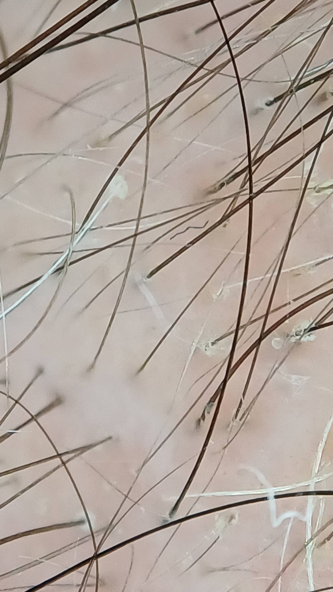 Bestimmung der benötigten Grafts bei einer Haartransplantation anhand der Haardichte und Haarstruktur