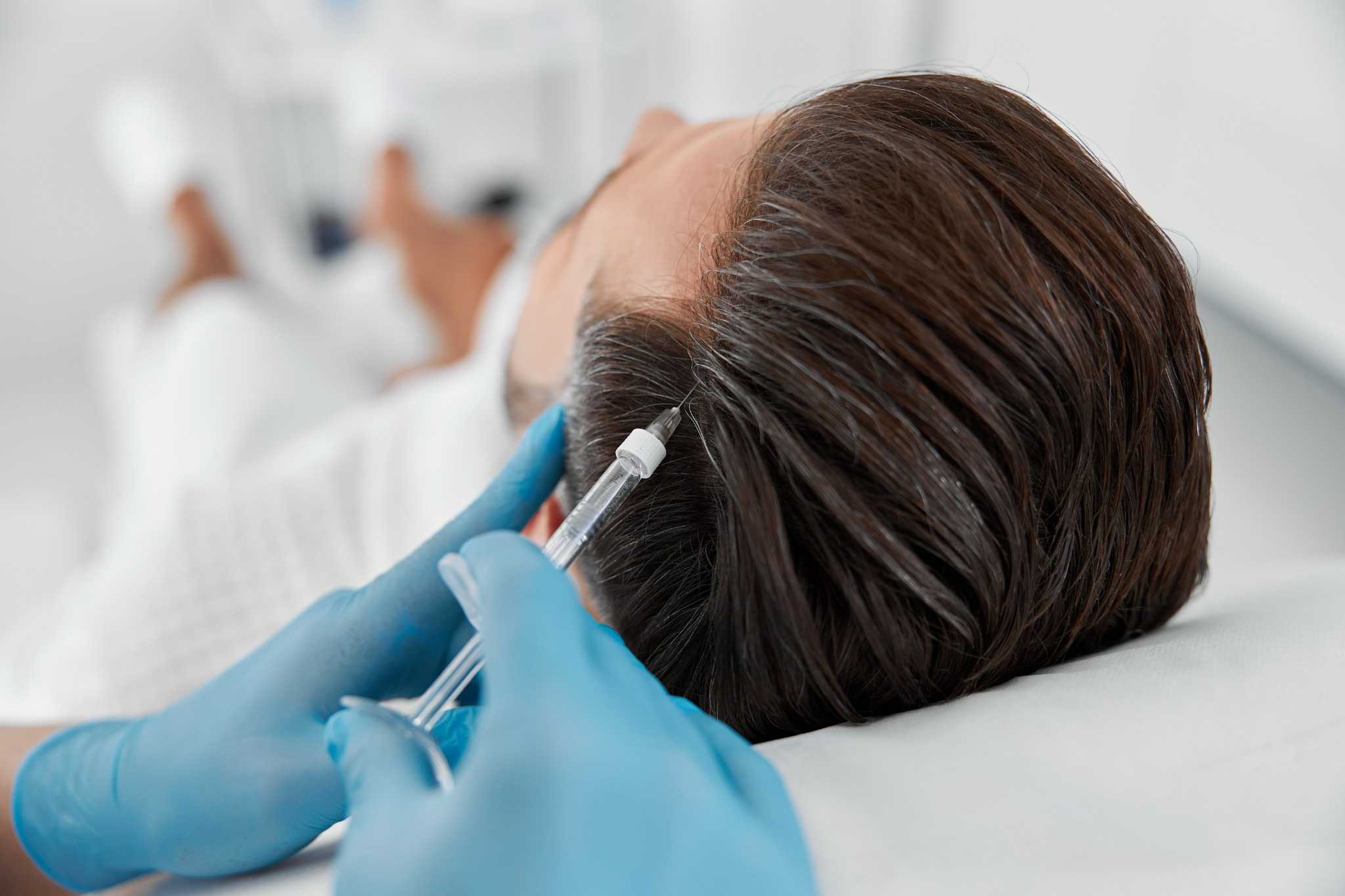 PRP Behandlung nach Haartransplantation zur Unterstützung der Heilung