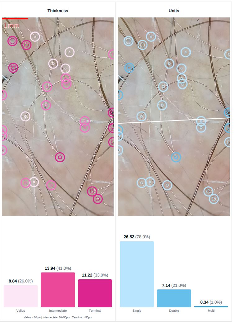 Trichoscan Analyse zur Bestimmung von Haardichte und Haarwachstum