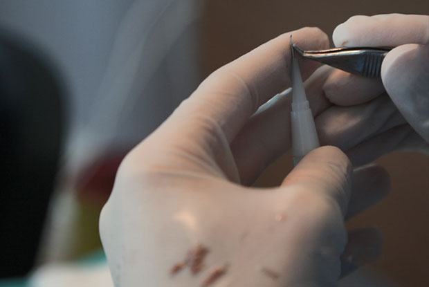 Implanteur Choi chargé d'un greffon capillaire lors d'une greffe DHI à la Medhair Clinic en Turquie.