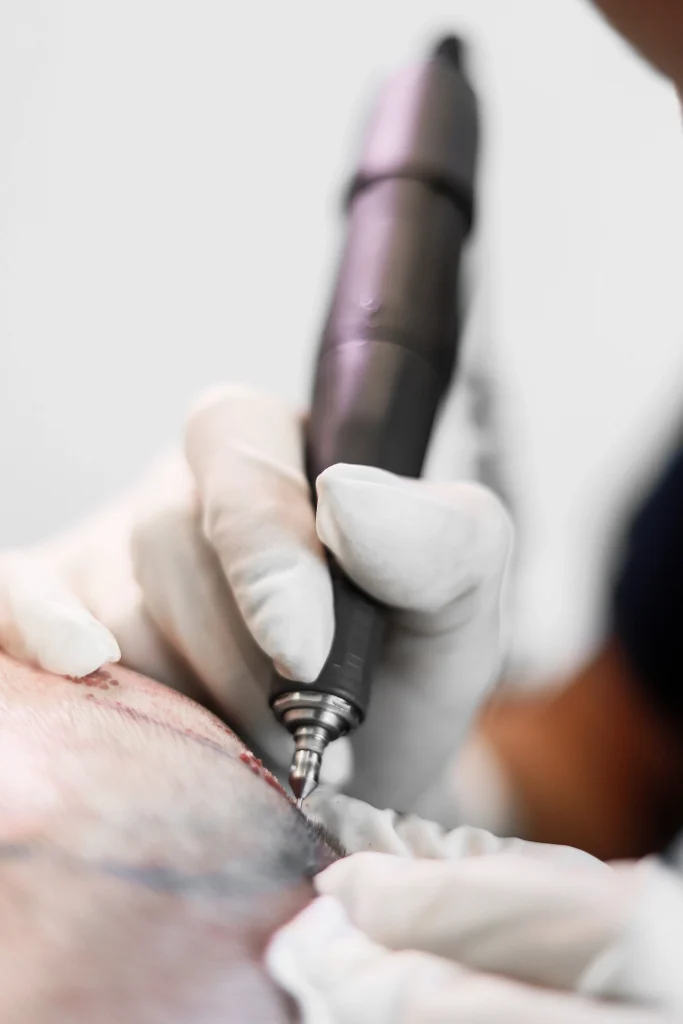 Spécialiste réalisant une greffe de cheveux FUE chez MedHairClinic, implantation des greffons capillaires sur le cuir chevelu avec un stylo implanteur.
