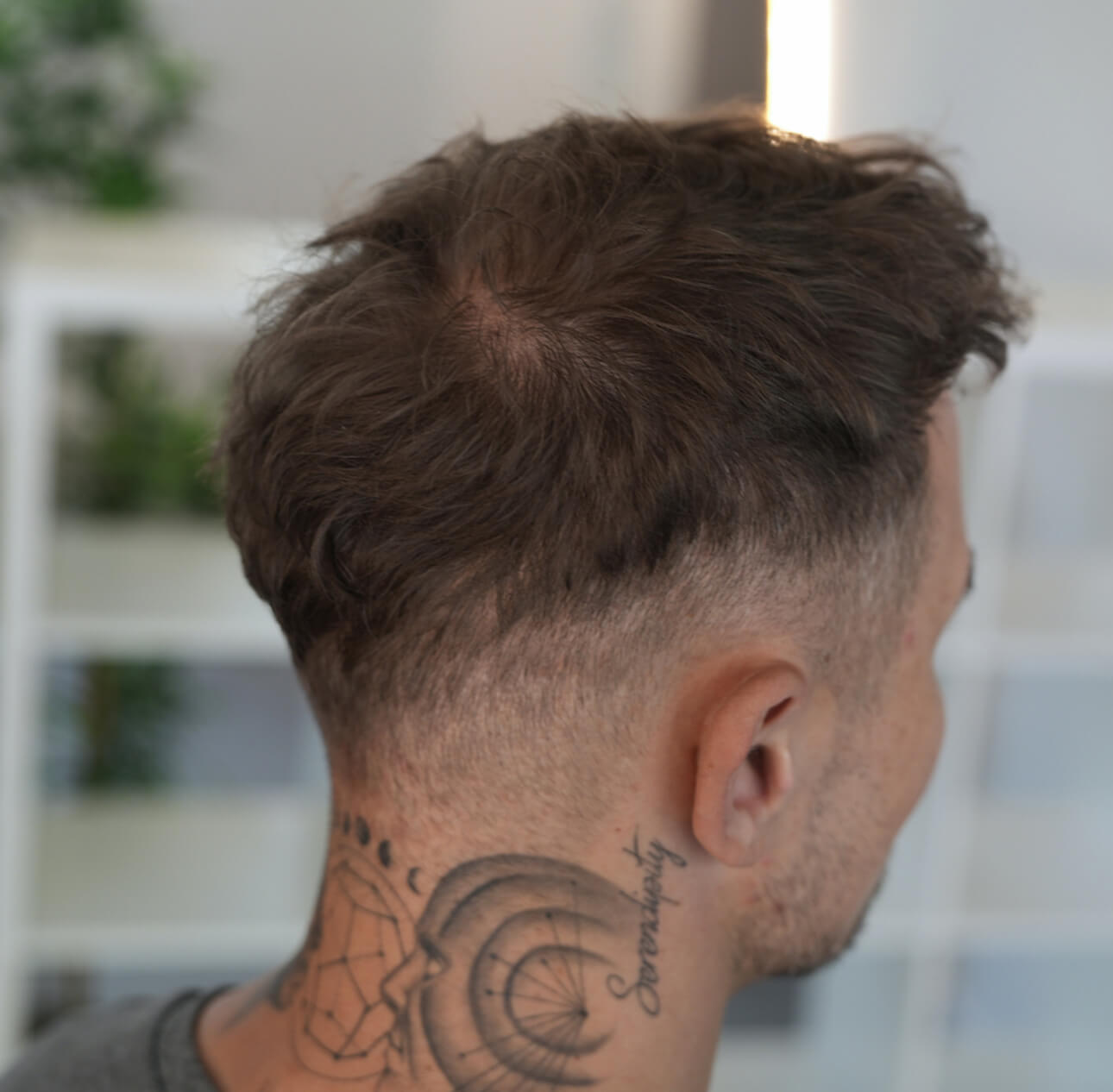 Haartransplantation-nachher-Spenderbereich.jpg