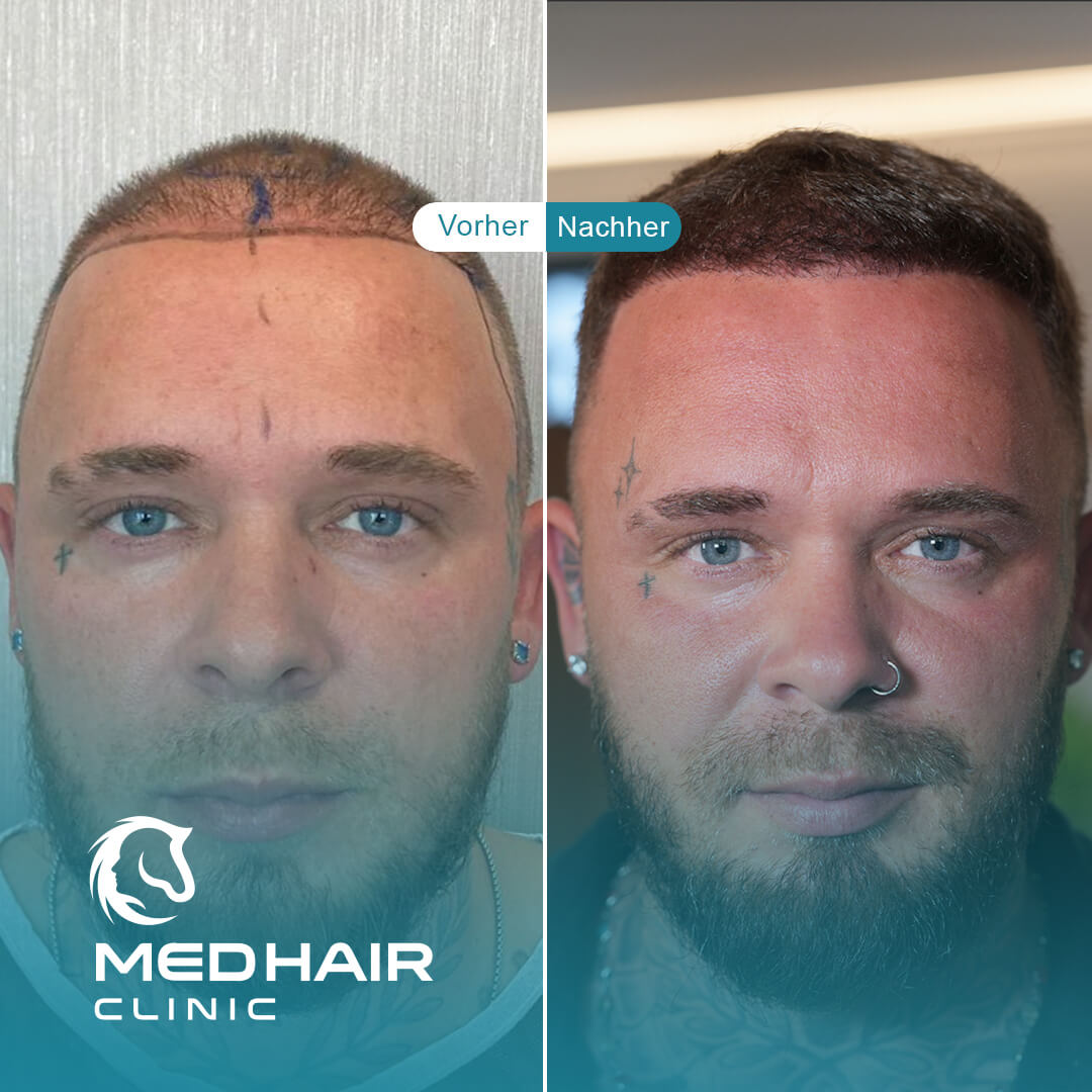 Haartransplantation-vorher-nachher-3500-grafts.jpg