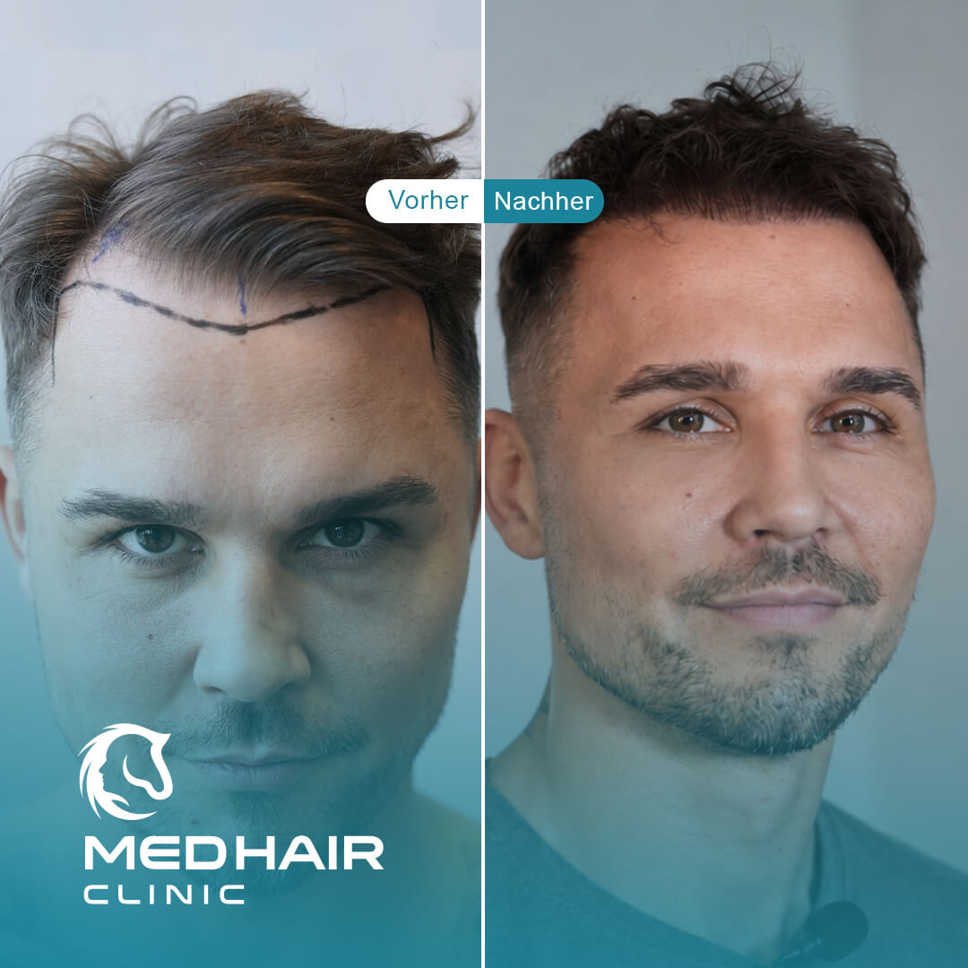 Haartransplantation-vorher-nachher-3800-Grafts.jpg