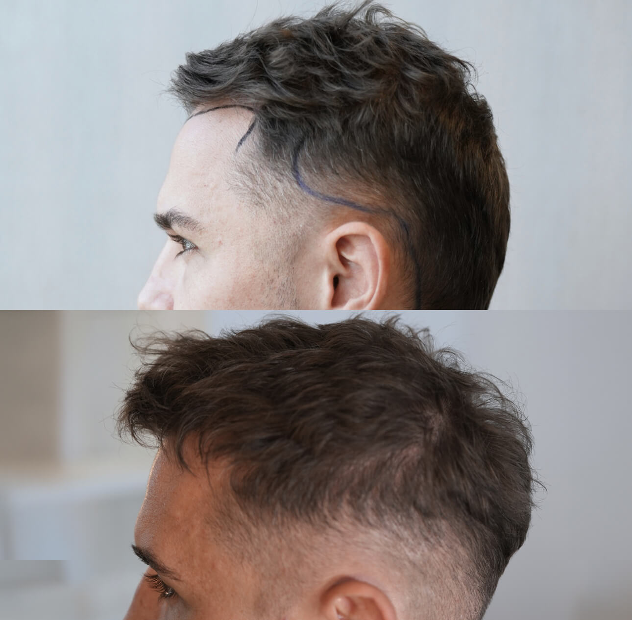 Haartransplantation-vorher-nachher-linke-Seite-1.jpg