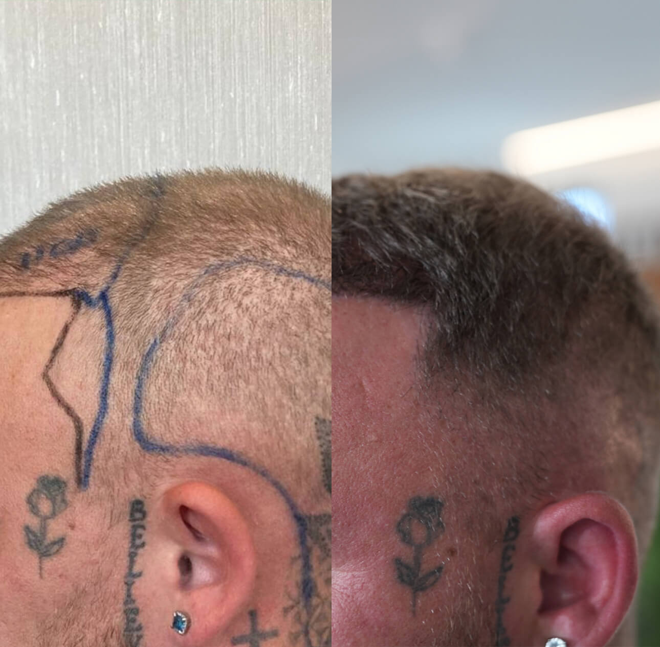 Haartransplantation-vorher-nachher-linke-Seite.jpg