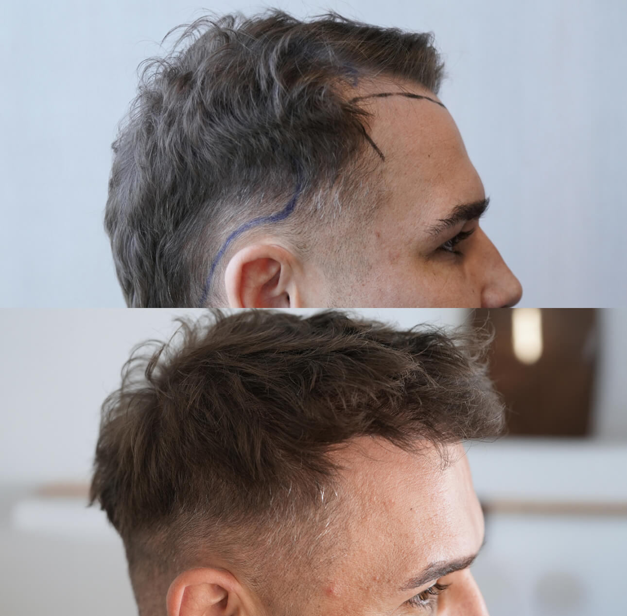 Haartransplantation-vorher-nachher-rechte-Seite.jpg