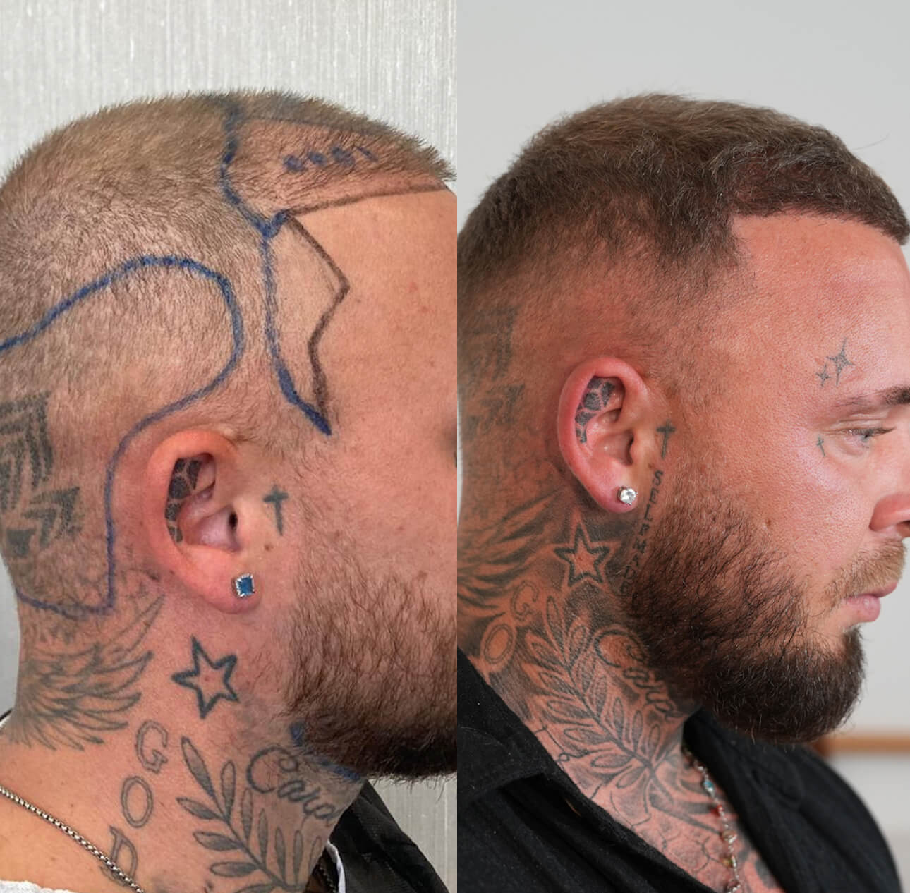 Haartransplantation-vorher-nachher-rechte-seite.jpeg