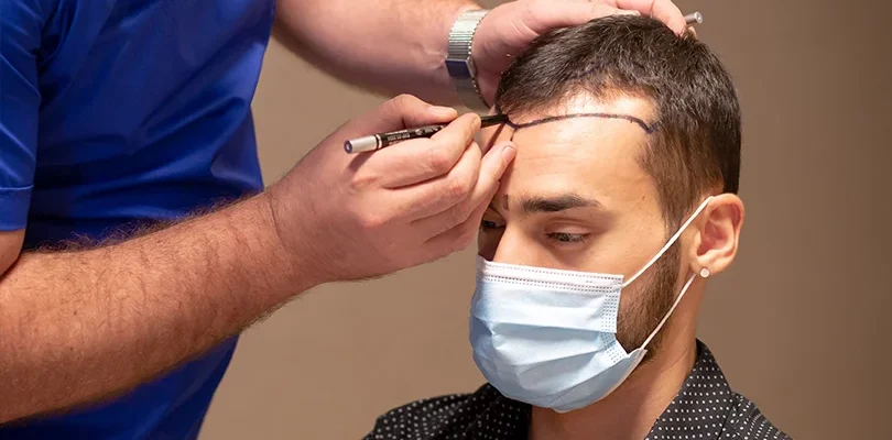 Saç ekimi öncesi doktor tarafından hastanın ön saç çizgisinin kalemle işaretlenmesi