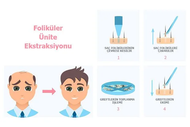 Foliküler Ünite Ekstraksiyonu (FUE) aşamalarını gösteren infografik: saç foliküllerinin çevresinin kesilmesi, foliküllerin çıkarılması, greftlerin toplanması ve greftlerin ekimi; öncesi-sonrası görseliyle birlikte.