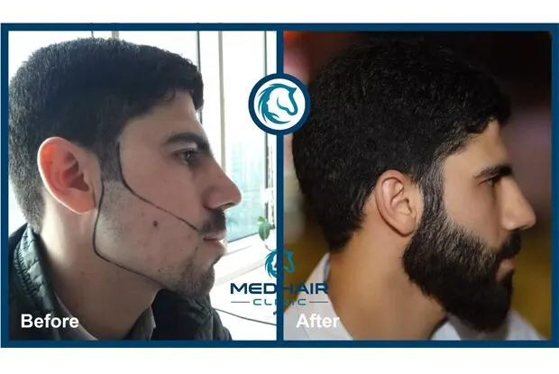 Sakal ekimi öncesi ve sonrası fotoğraflarıyla gerçek hasta sonuçlarını görün. Seyrek sakaldan sık ve doğal görünüme MEDHAIR Clinic farkıyla kavuşun.