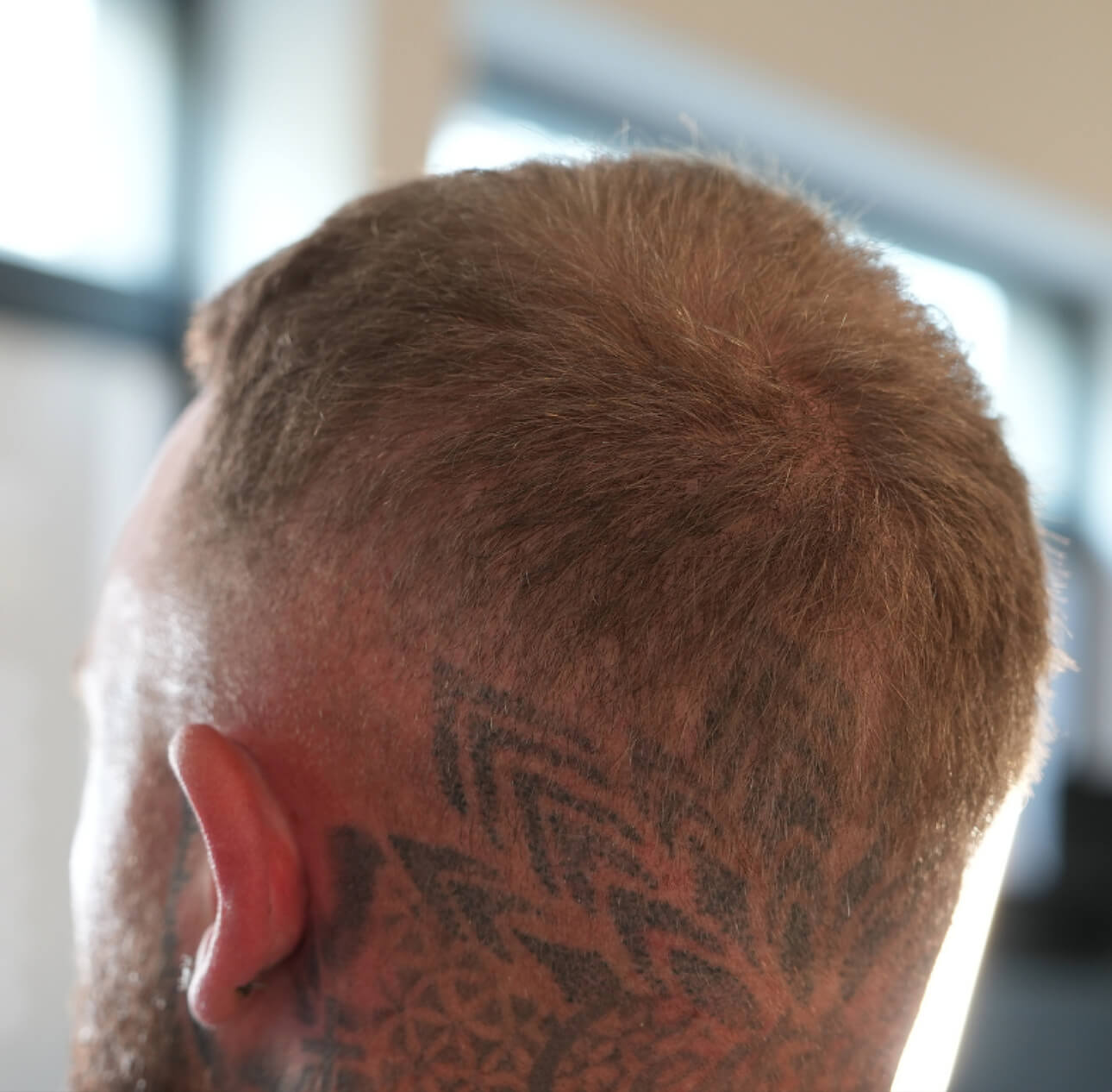 Spenderbereich-nach-Haartransplantation.jpg