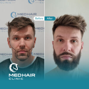 Beard-transplant-turkey-before-and-after-1