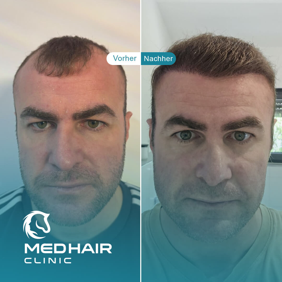 Haartransplantation von Peter mit 3400 Grafts mit der DHI Methode