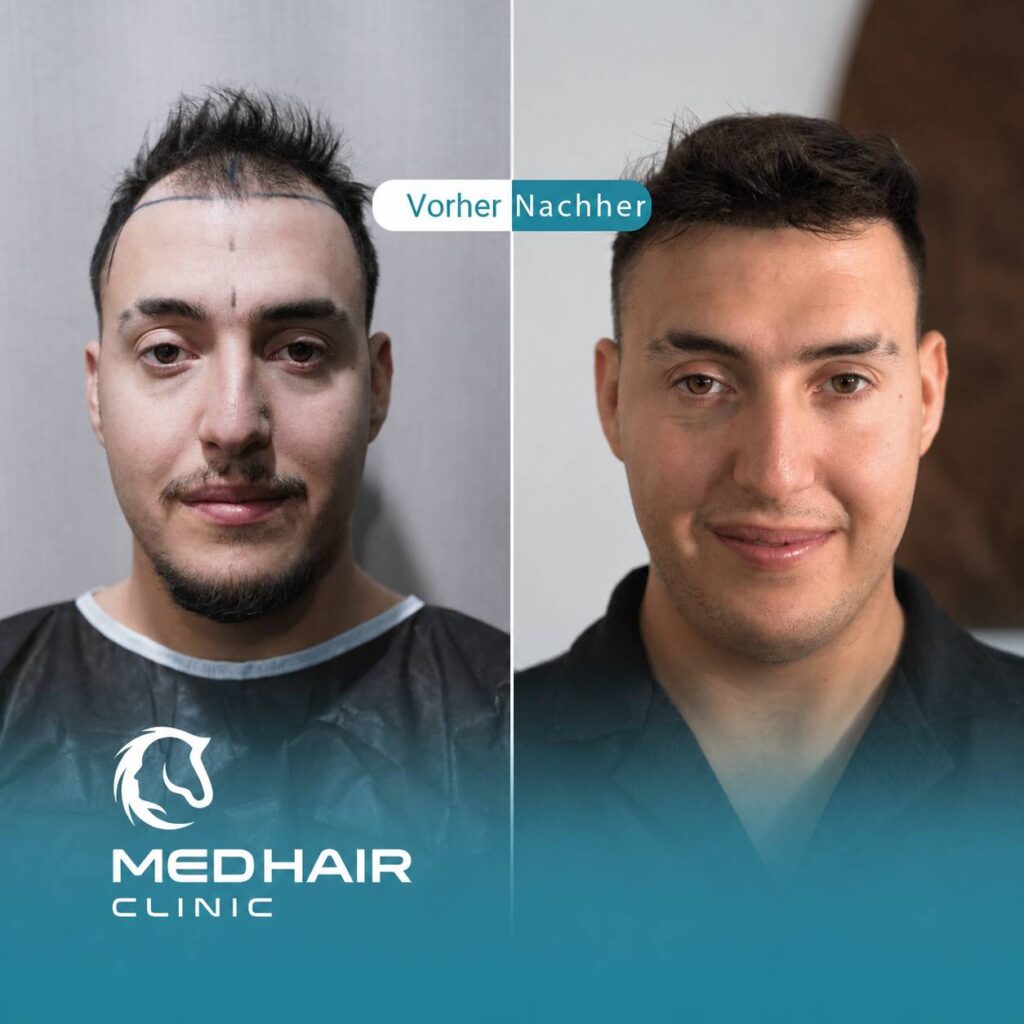Haartransplantation vorher nachher – natürliches Ergebnis sechs Monate nach der Haartransplantation in der Türkei