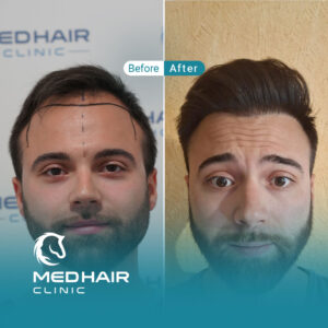 Hair-implant-Turkey-before-and-after