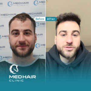 Hair-transplant-Turkey-before-and-after-2800-grafts