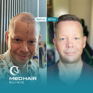 Hair-transplant-Turkey-before-and-after-3000-grafts