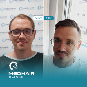 Hair-transplant-Turkey-before-and-after