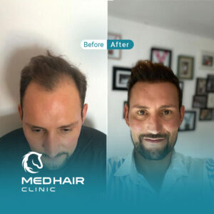 Hair-transplant-before-and-after-3300-grafts