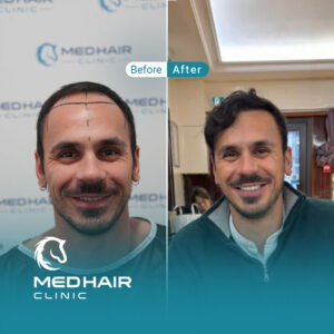 Hair-transplant-before-and-after-3600-Grafts