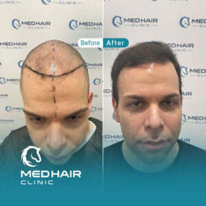 Hair-transplant-before-and-after-4200-grafts