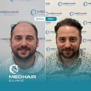 Hair-transplant-before-and-after-4800-grafts