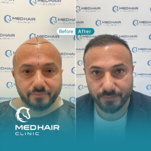 Hair-transplant-before-and-after-4900-grafts