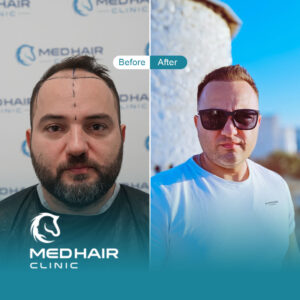 Hair-transplant-before-and-after-Istanbul