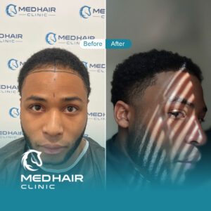 Hair-transplant-before-and-after-Turkey