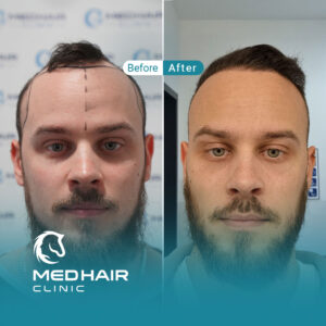Hair-transplant-before-and-after-Turkey-4500-grafts