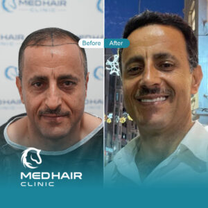 Hair-transplant-before-and-after-Turkey-Result