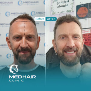Hair-transplant-before-and-after-in-Turkey
