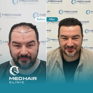 Hair-transplant-before-and-after-results