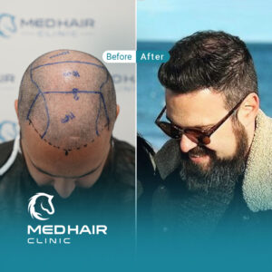 Hair-transplant-before-and-after-tonsure