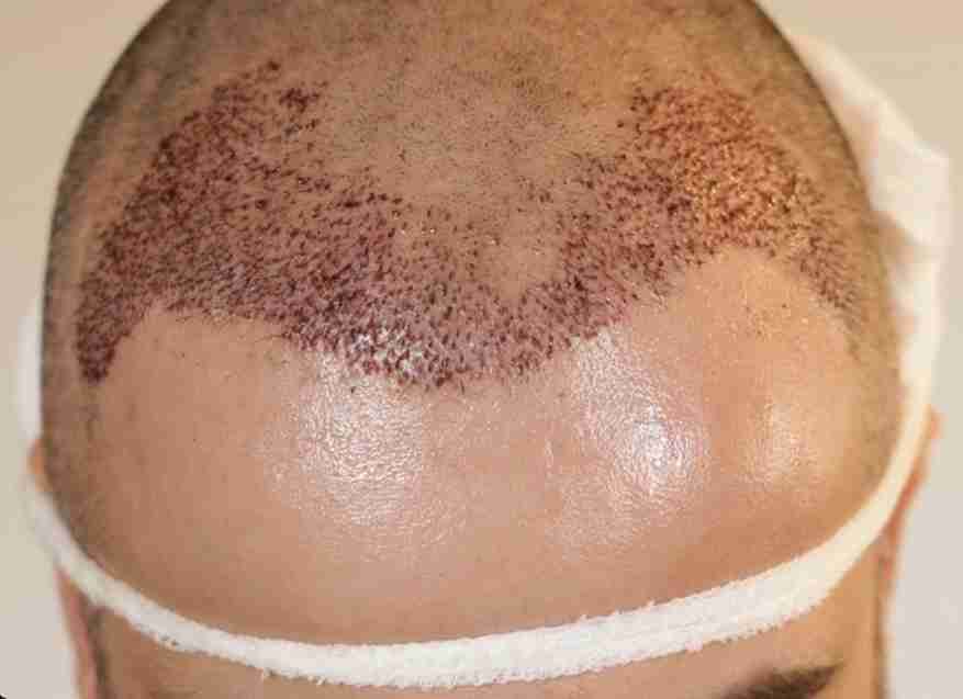 Zone receveuse du cuir chevelu après une greffe de cheveux avec gonflement visible au niveau du front.